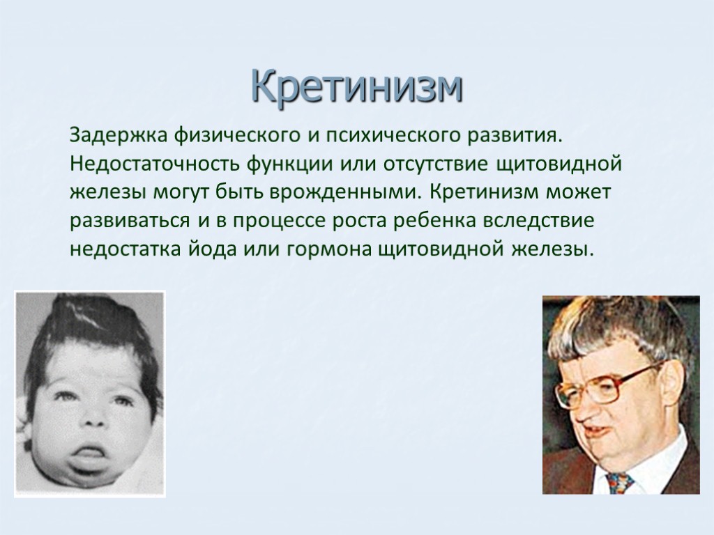 Кретинизм Задержка физического и психического развития. Недостаточность функции или отсутствие щитовидной железы могут быть